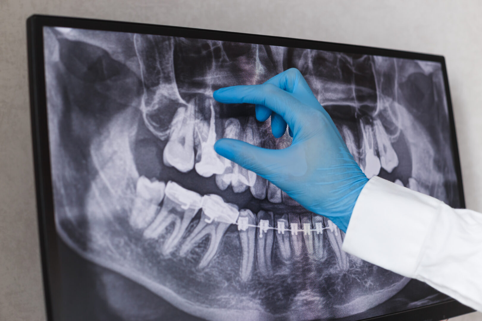 Doctor points to filled root canal in dental x ray